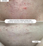 Ingrown Hair & Pre-Post Wax Oil- SWEET ESCAPE